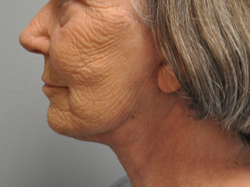 Co2 Laser Before and After | Little Lipo