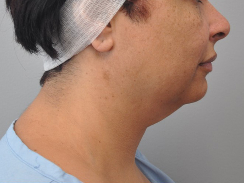Co2 Laser Before and After | Little Lipo
