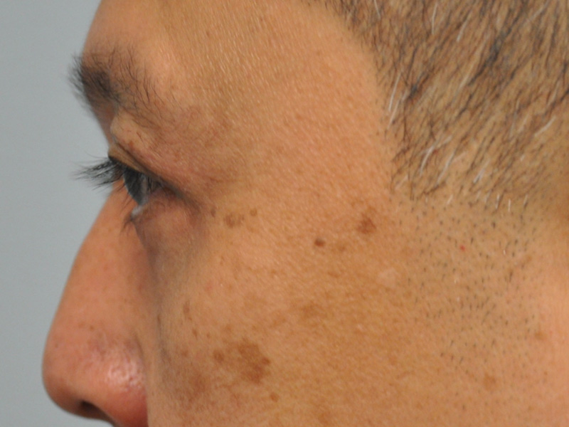 Co2 Laser Before and After | Little Lipo