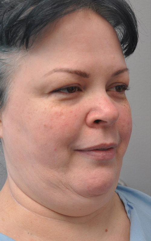 Co2 Laser Before and After | Little Lipo