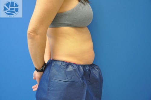 Coolsculpting Abdomen Before and After | Little Lipo