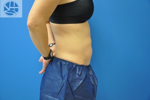 Coolsculpting Abdomen Before and After | Little Lipo