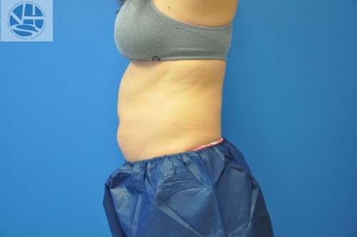 Coolsculpting Abdomen Before and After | Little Lipo