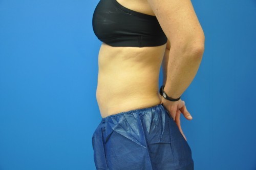 Coolsculpting Abdomen Before and After | Little Lipo