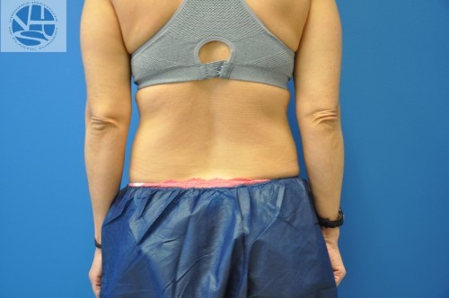 Coolsculpting Abdomen Before and After | Little Lipo