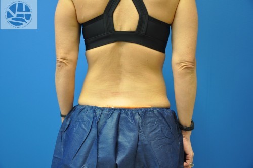 Coolsculpting Abdomen Before and After | Little Lipo