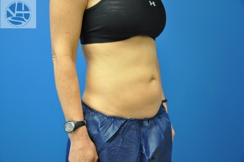 Coolsculpting Abdomen Before and After | Little Lipo