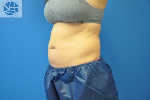 Coolsculpting Abdomen Before and After | Little Lipo