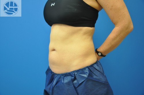 Coolsculpting Abdomen Before and After | Little Lipo