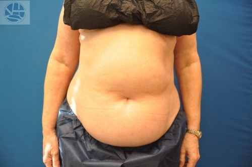 Coolsculpting Abdomen Before and After | Little Lipo