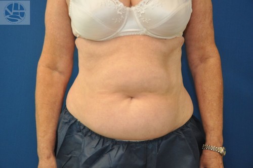 Coolsculpting Abdomen Before and After | Little Lipo