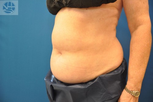 Coolsculpting Abdomen Before and After | Little Lipo