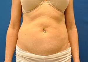 Coolsculpting Abdomen Before and After | Little Lipo