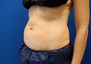 Coolsculpting Abdomen Before and After | Little Lipo