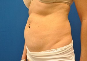 Coolsculpting Abdomen Before and After | Little Lipo