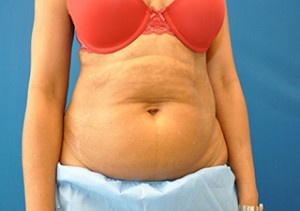 Coolsculpting Abdomen Before and After | Little Lipo