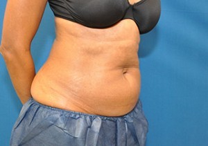 Coolsculpting Abdomen Before and After | Little Lipo