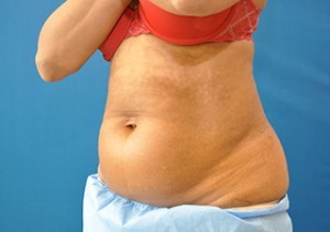 Coolsculpting Abdomen Before and After | Little Lipo