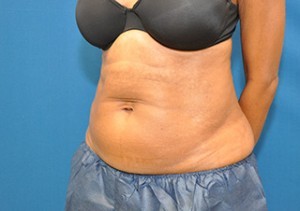 Coolsculpting Abdomen Before and After | Little Lipo