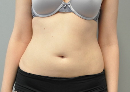 Coolsculpting Abdomen Before and After | Little Lipo