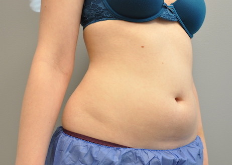 Coolsculpting Abdomen Before and After | Little Lipo