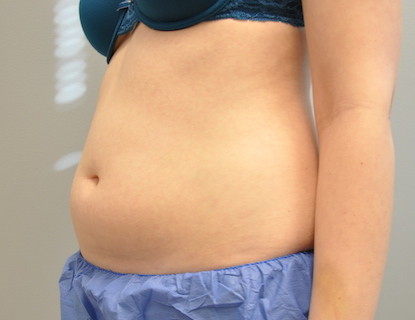 Coolsculpting Abdomen Before and After | Little Lipo