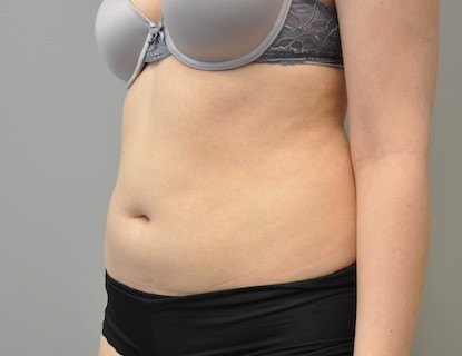 Coolsculpting Abdomen Before and After | Little Lipo