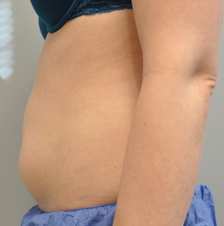 Coolsculpting Abdomen Before and After | Little Lipo