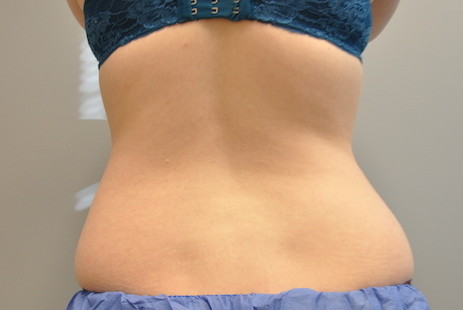 Coolsculpting Abdomen Before and After | Little Lipo