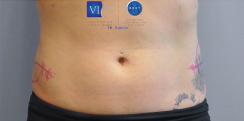 Coolsculpting Abdomen Before and After | Little Lipo