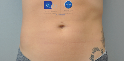 Coolsculpting Abdomen Before and After | Little Lipo