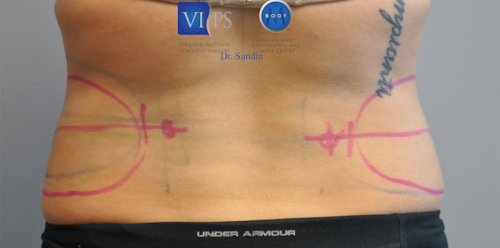 Coolsculpting Abdomen Before and After | Little Lipo