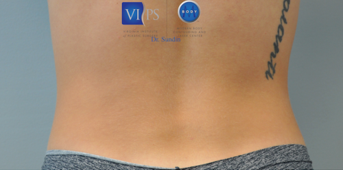 Coolsculpting Abdomen Before and After | Little Lipo