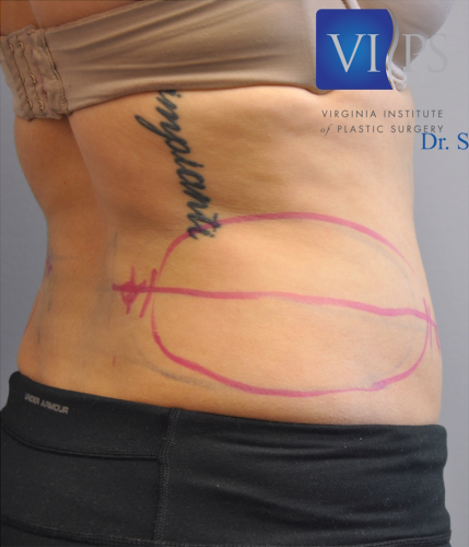 Coolsculpting Abdomen Before and After | Little Lipo