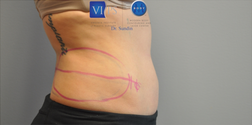 Coolsculpting Abdomen Before and After | Little Lipo