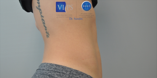 Coolsculpting Abdomen Before and After | Little Lipo