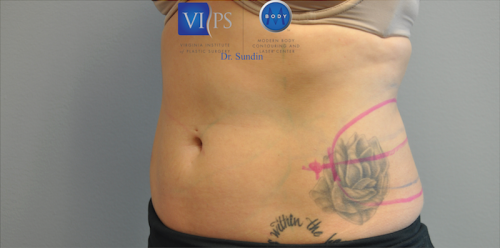 Coolsculpting Abdomen Before and After | Little Lipo