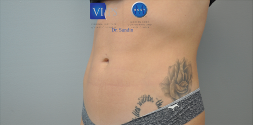 Coolsculpting Abdomen Before and After | Little Lipo