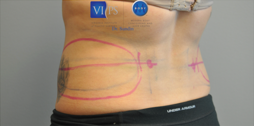 Coolsculpting Abdomen Before and After | Little Lipo