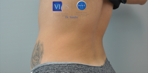 Coolsculpting Abdomen Before and After | Little Lipo