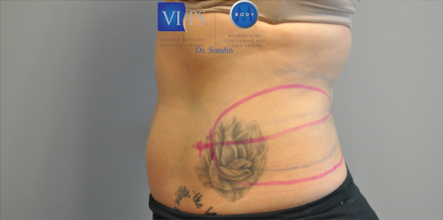 Coolsculpting Abdomen Before and After | Little Lipo