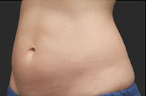 Coolsculpting Abdomen Before and After | Little Lipo