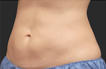 Coolsculpting Abdomen Before and After | Little Lipo