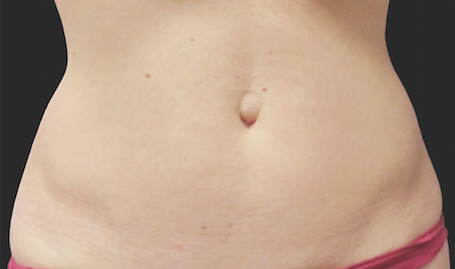 Coolsculpting Abdomen Before and After | Little Lipo