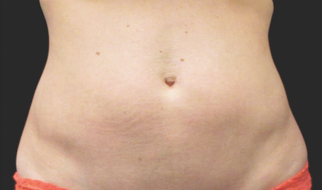 Coolsculpting Abdomen Before and After | Little Lipo