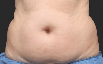 Coolsculpting Abdomen Before and After | Little Lipo