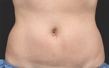 Coolsculpting Abdomen Before and After | Little Lipo