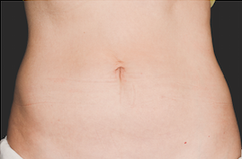 Coolsculpting Abdomen Before and After | Little Lipo