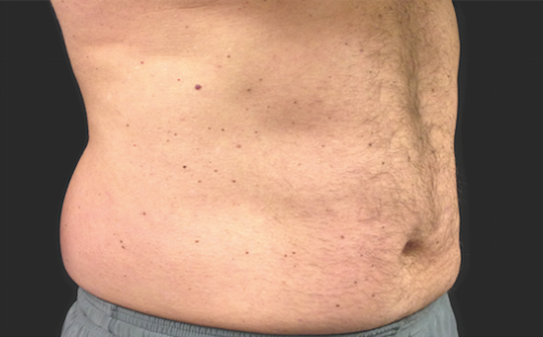 Coolsculpting Abdomen Before and After | Little Lipo