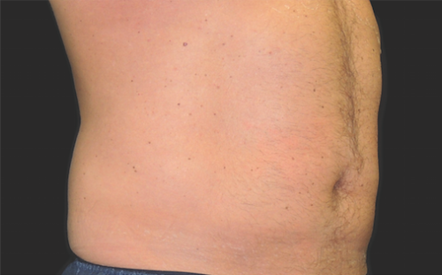 Coolsculpting Abdomen Before and After | Little Lipo